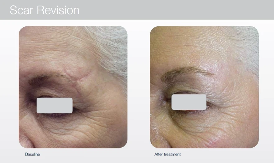 Laser-Scar-Treatment