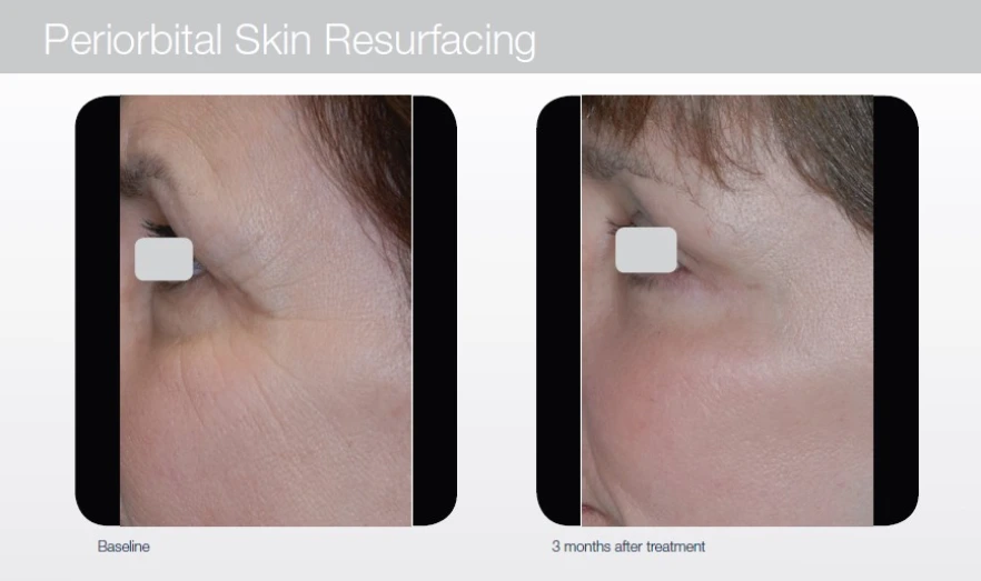 PeriorbitalSkinResurfacing