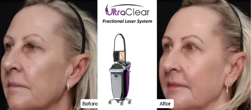 Acclaro-Ultraclear-Laser