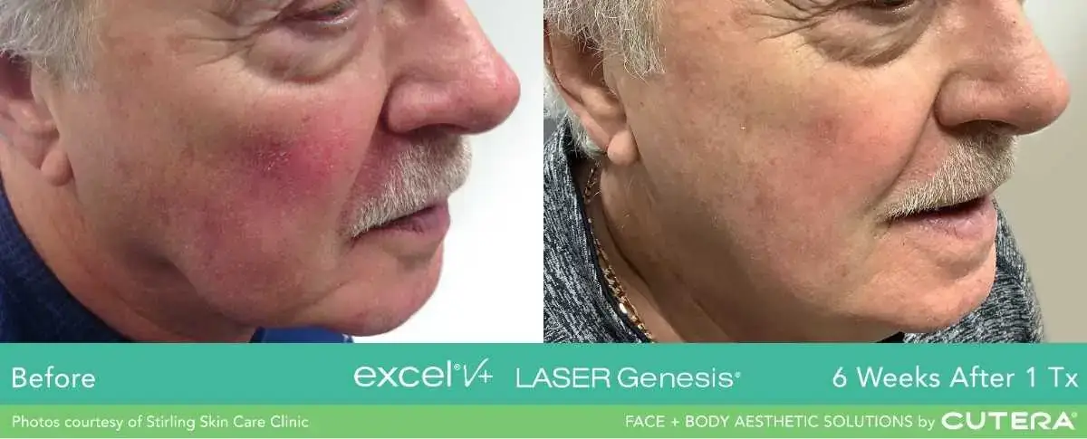 CuteraExcelVVascular-PigmentLaser-Dr-Alans-Clinic