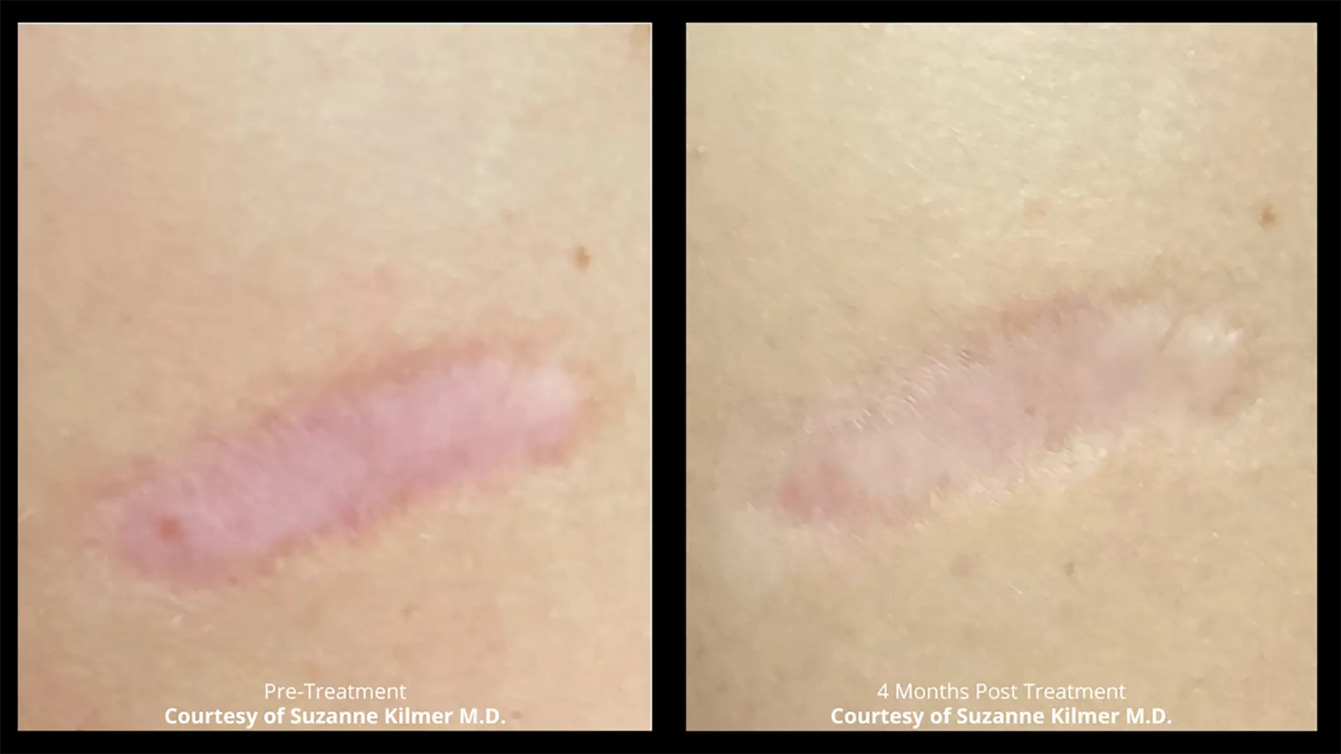 Laser-BA-Scarring-Dr