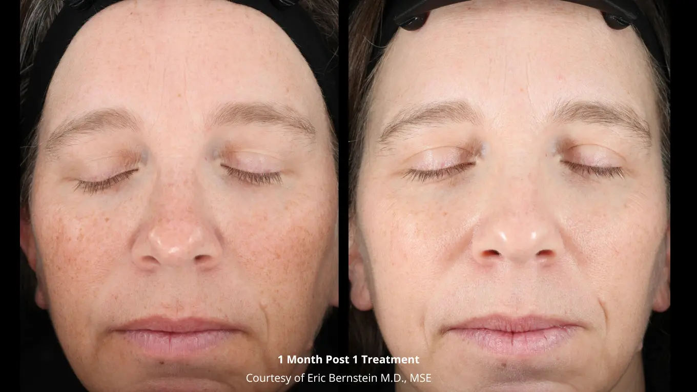 Laser-Before-and-After_-Bernstein-1