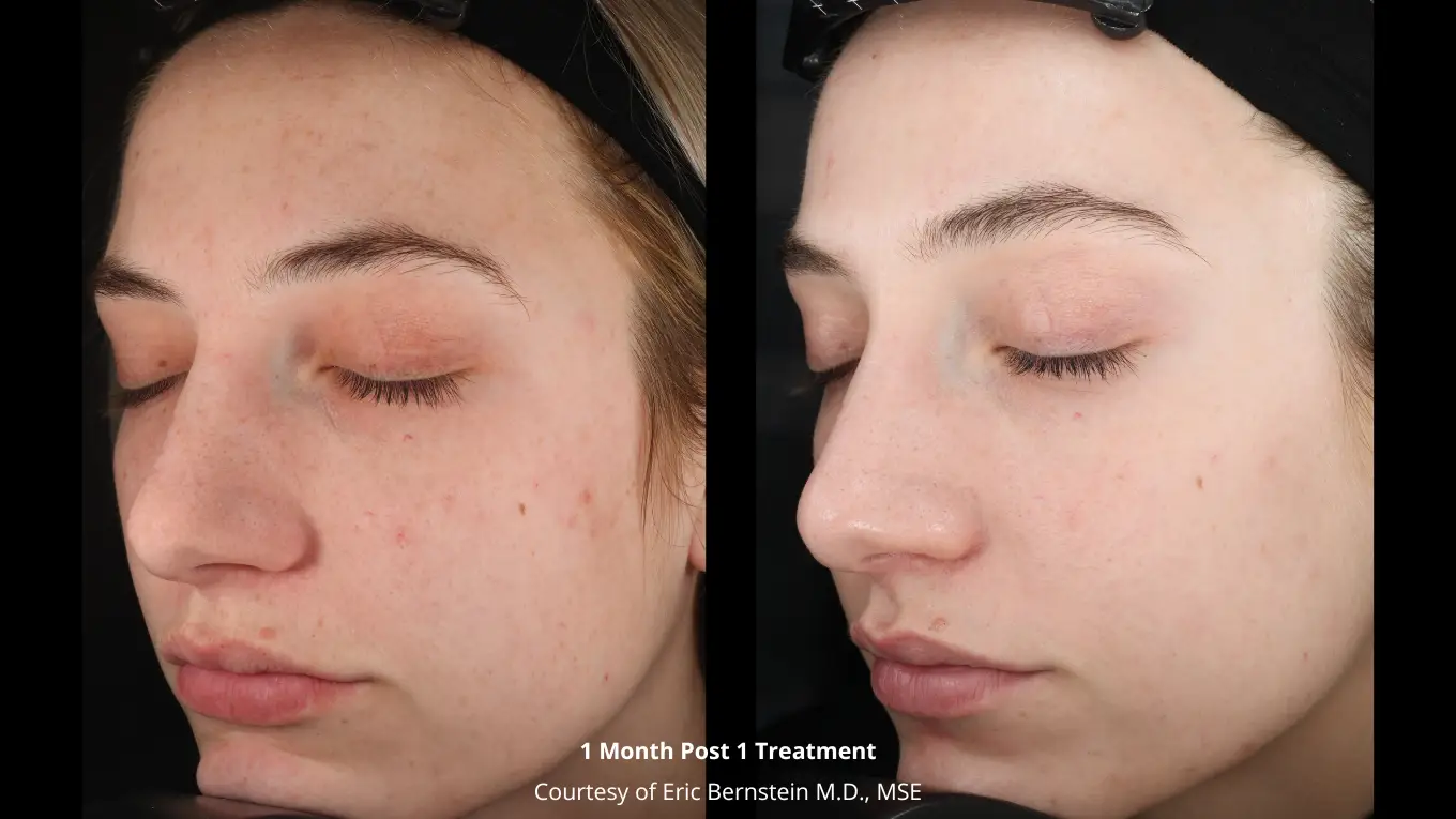 Laser-Before-and-After_-Bernstein-2
