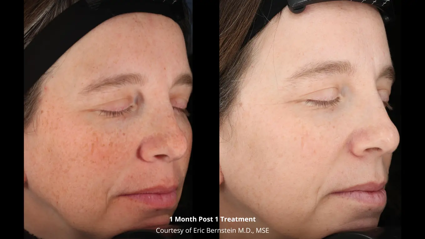 Laser-Before-and-After_-Bernstein-3