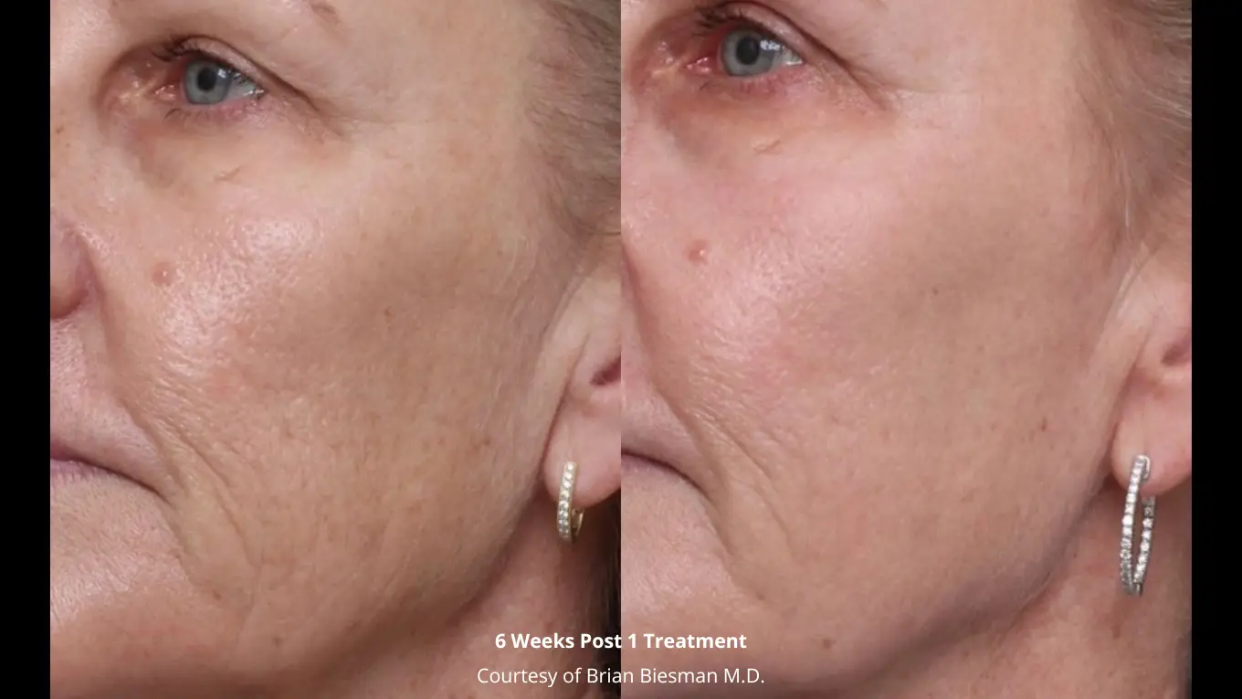 Laser-Before-and-After_-Biesman