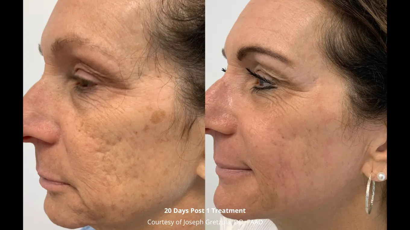 Laser-BeforeAfters-Website-18