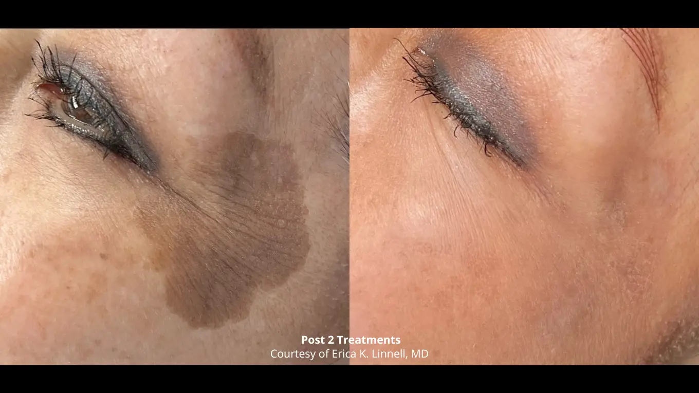Laser-BeforeAfters-Website-19