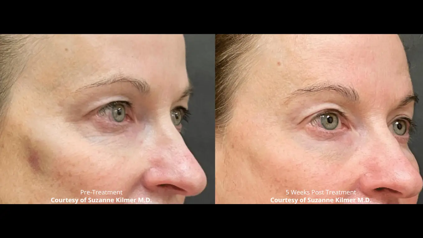 Laser-BeforeAfters-Website-9