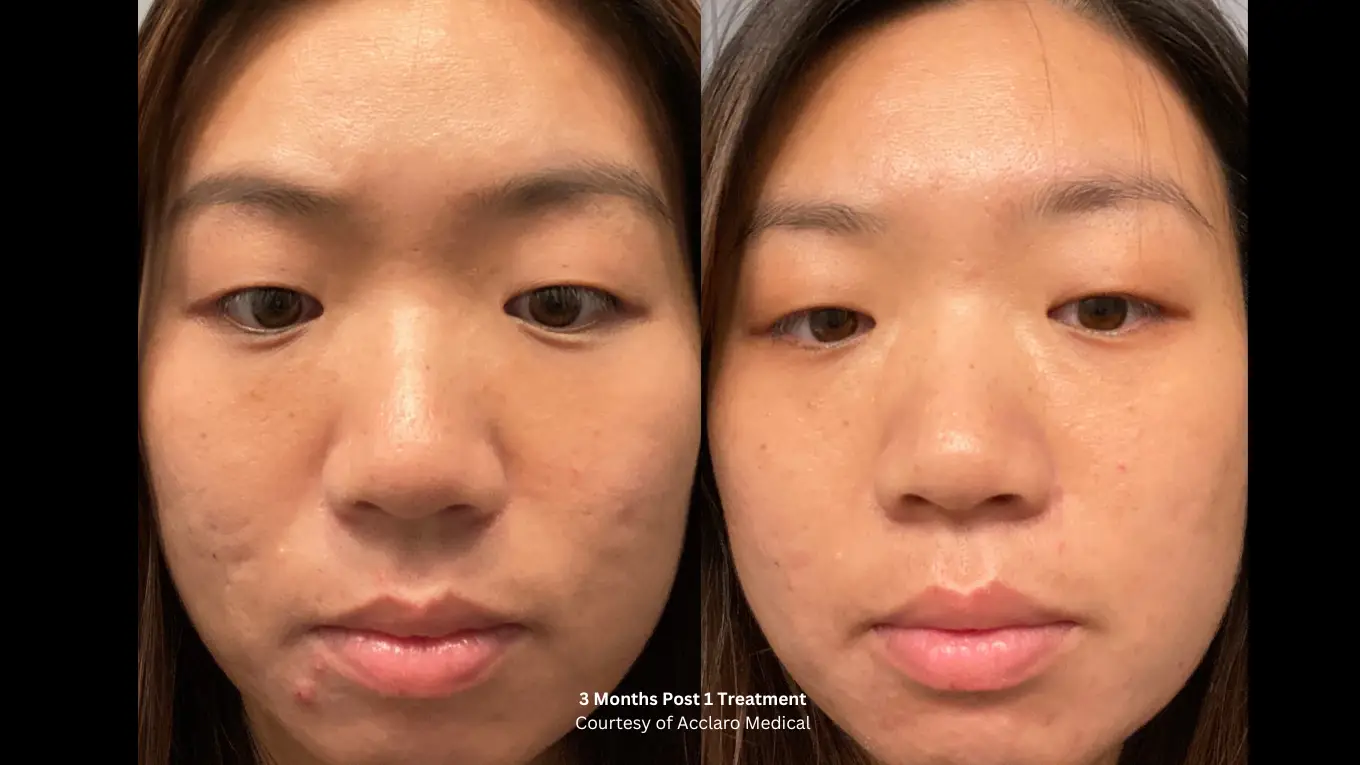 Laser-Beforeafter-5