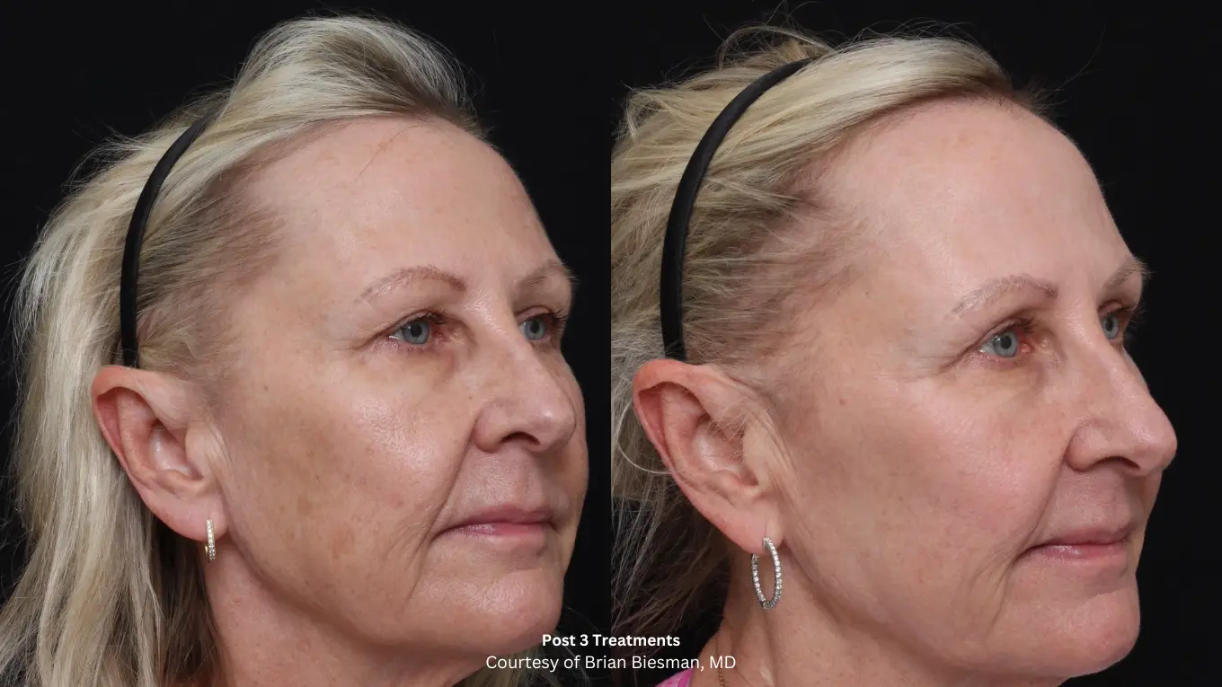 Laser-Beforeafter-7