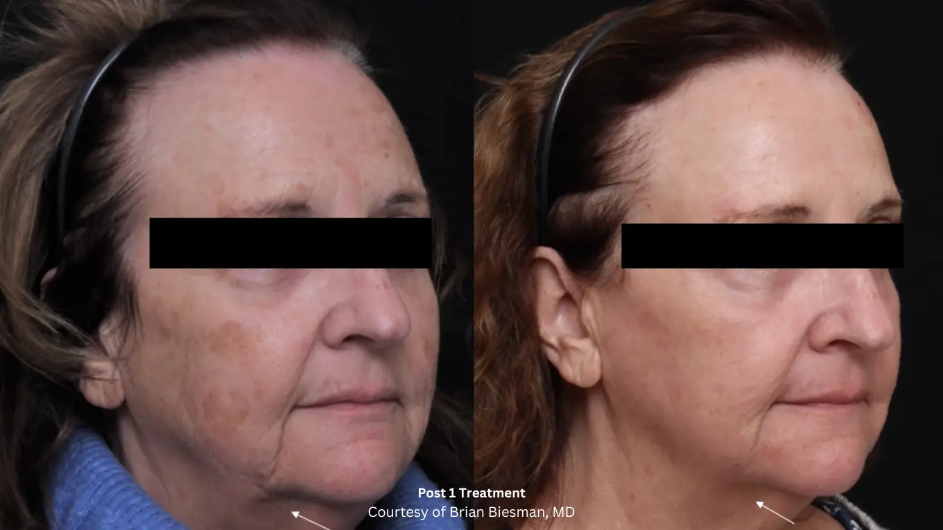 Laser-Beforeafter-Biesmasn-1