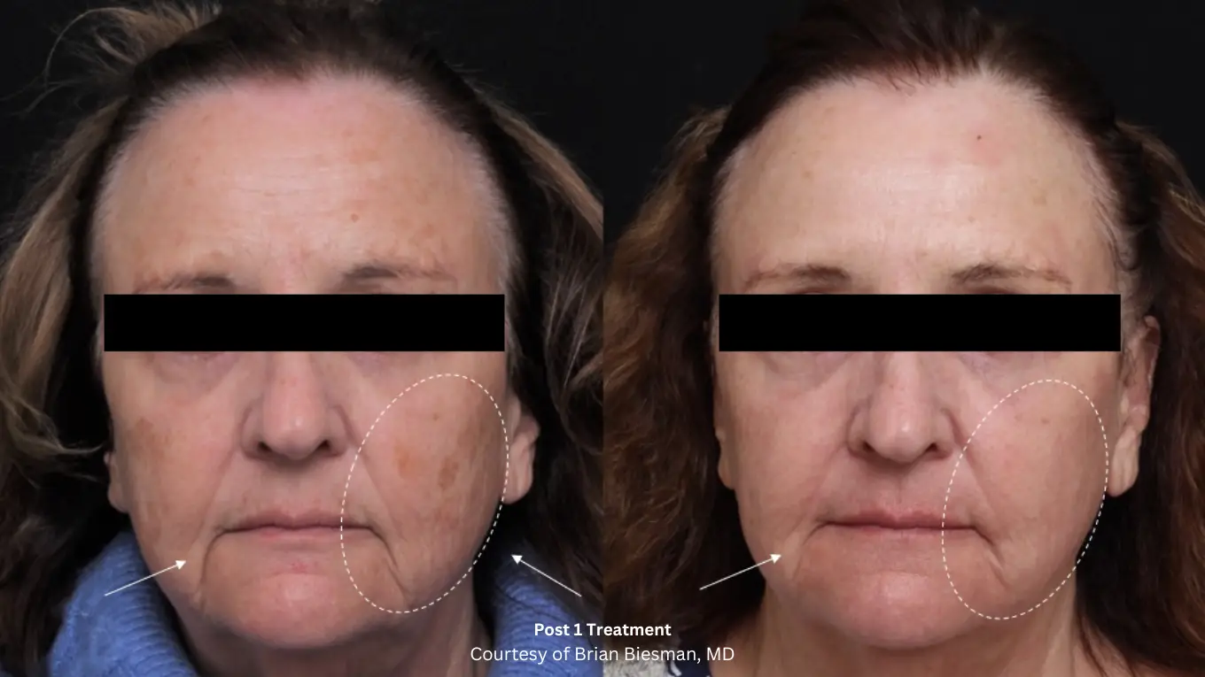 Laser-Beforeafter-Biesmasn
