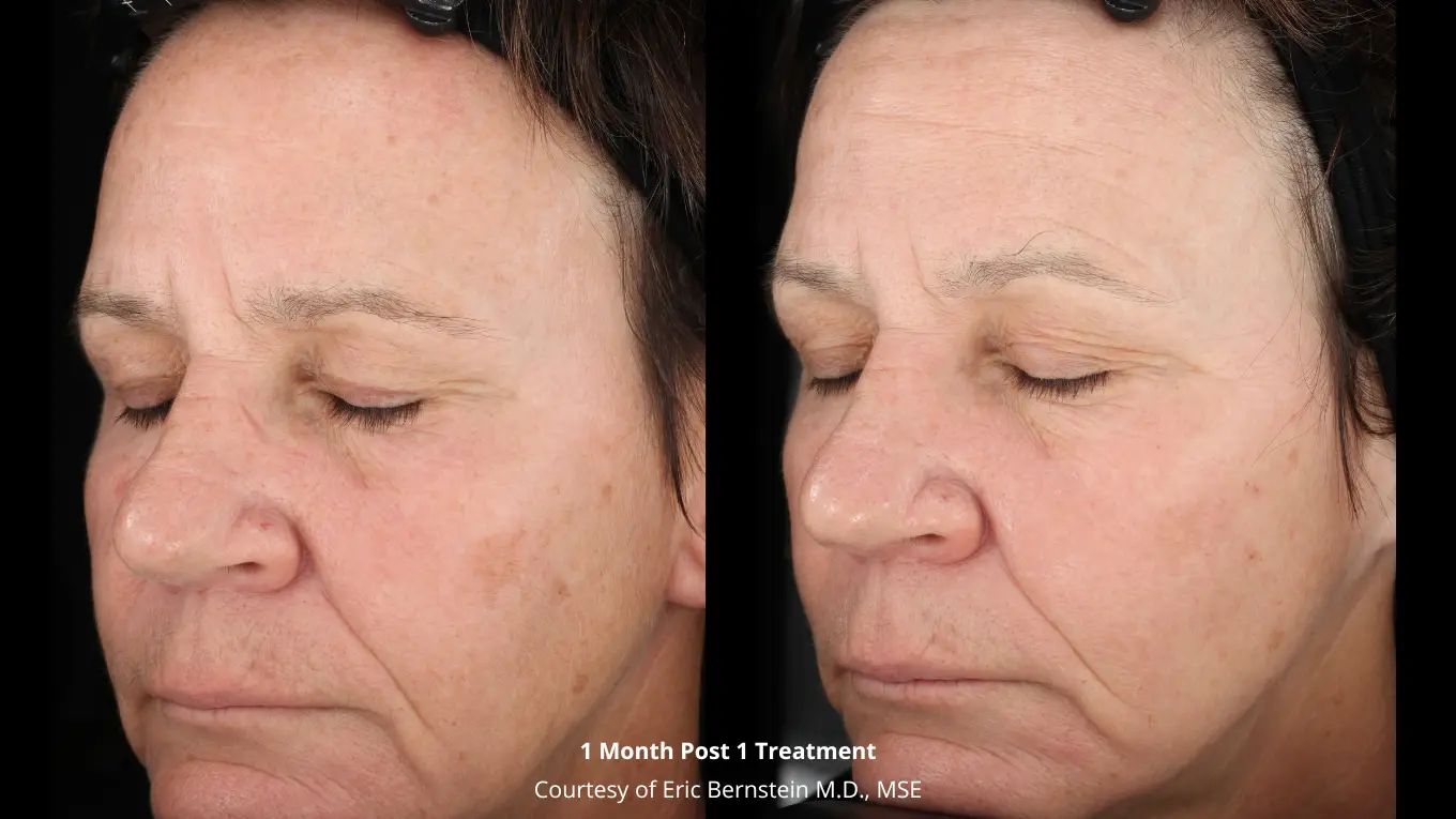 Laser-Green-Testimonial-Instagram-Post-300-×-300-px-1360-×-765-px-10-1