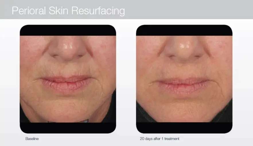 Perioral-Resurfacing