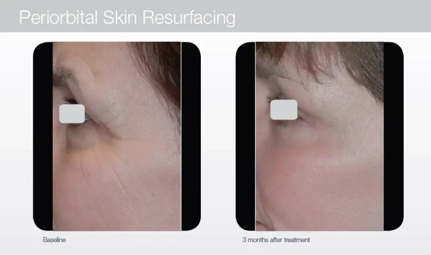 PeriorbitalSkinResurfacing