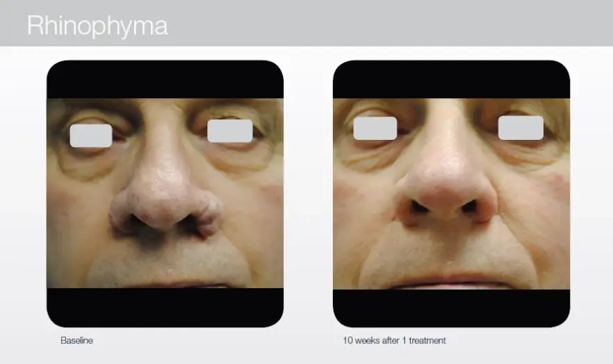 Rhinophyma-CO2