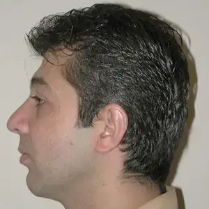Rhinoplasty-after3