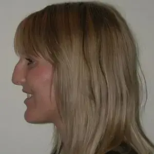 Rhinoplasty-before1