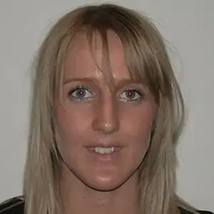 Rhinoplasty-before2