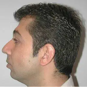 Rhinoplasty-before3